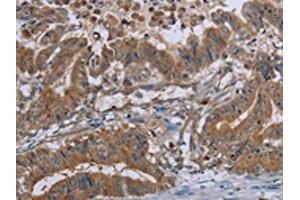 The image on the left is immunohistochemistry of paraffin-embedded Human esophagus cancer tissue using ABIN7130067(LCMT1 Antibody) at dilution 1/20, on the right is treated with fusion protein. (LCMT1 Antikörper)