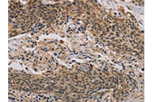 The image on the left is immunohistochemistry of paraffin-embedded Human cervical cancer tissue using ABIN7190296(CLEC5A Antibody) at dilution 1/20, on the right is treated with synthetic peptide. (CLEC5A Antikörper)