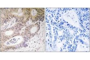 Immunohistochemistry analysis of paraffin-embedded human colon carcinoma tissue, using MSK1 (Ab-212) Antibody. (MSK1 Antikörper  (AA 181-230))