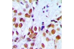 Immunohistochemical analysis of RAD54A staining in human breast cancer formalin fixed paraffin embedded tissue section. (RAD54L Antikörper)