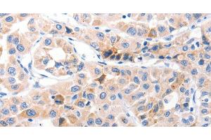 Immunohistochemistry of paraffin-embedded Human lung cancer using CDK7 Polyclonal Antibody at dilution of 1:30 (CDK7 Antikörper)