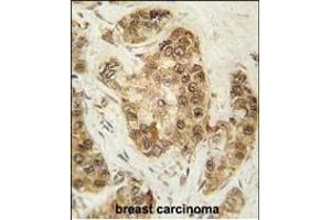 Formalin-fixed and paraffin-embedded human breast carcinoma tissue reacted with CDK2 Antibody (T14) (ABIN1881192 and ABIN2841623) , which was peroxidase-conjugated to the secondary antibody, followed by DAB staining. (CDK2 Antikörper  (AA 1-30))