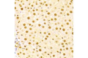 Immunohistochemistry of paraffin-embedded human liver damage using CDC25A antibody (ABIN3021625, ABIN3021626, ABIN3021627 and ABIN6215426) at dilution of 1:100 (40x lens). (CDC25A Antikörper  (AA 235-484))