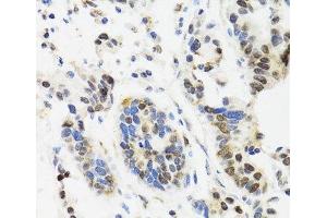 Immunohistochemistry of paraffin-embedded Human gastric cancer using TOP1 Polyclonal Antibody at dilution of 1:100 (40x lens). (Topoisomerase I Antikörper)