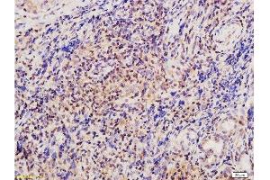 Formalin-fixed and paraffin embedded human nasopharyngeal carcinoma tissue labeled with Anti-Twist Polyclonal Antibody , Unconjugated at 1:200 followed by conjugation to the secondary antibody, (SP-0023), and DAB staining (TWIST1, TWIST2 (AA 71-170) Antikörper)