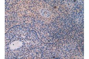 IHC-P analysis of Human Skin Cancer Tissue, with DAB staining. (IFI16 Antikörper  (AA 465-671))