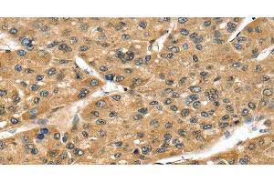 Immunohistochemistry of paraffin-embedded Human liver cancer tissue using STX8 Polyclonal Antibody at dilution 1:45 (STX8 Antikörper)