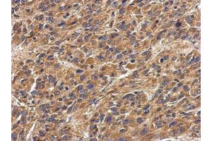 IHC-P Image Immunohistochemical analysis of paraffin-embedded human hepatoma, using HLA-DPA1, antibody at 1:500 dilution. (HLA-DPA1 Antikörper)