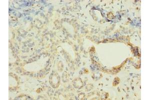 Immunohistochemistry of paraffin-embedded human breast cancer using ABIN7152421 at dilution of 1:100 (FBXO28 Antikörper  (AA 251-368))