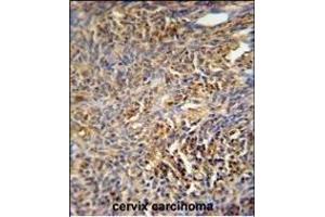 TANK Antibody (Center) (ABIN652041 and ABIN2840515) immunohistochemistry analysis in formalin fixed and paraffin embedded human cervix carcinoma followed by peroxidase conjugation of the secondary antibody and DAB staining. (TANK Antikörper  (AA 88-114))