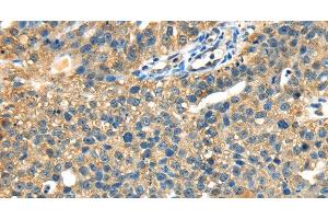 Immunohistochemistry of paraffin-embedded Human breast cancer tissue using DHCR24 Polyclonal Antibody at dilution 1:40 (Seladin 1 Antikörper)