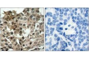 Immunohistochemistry analysis of paraffin-embedded human breast carcinoma tissue, using FKHRL1 (Ab-253) Antibody. (FOXO3 Antikörper  (AA 220-269))