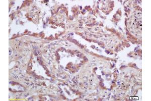 Formalin-fixed and paraffin embedded human lung carcinoma labeled with Rabbit Anti p53AIP1 Polyclonal Antibody, Unconjugated (ABIN872405) at 1:200 followed by conjugation to the secondary antibody and DAB staining