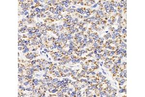 Immunohistochemistry analysis of paraffin-embedded human liver cancer using AGXT (ABIN7072987) at dilution of 1: 2000 (AGXT Antikörper)