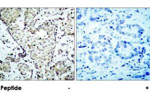 Immunohistochemical analysis of paraffin-embedded human breast carcinoma tissue using MAP2K6 polyclonal antibody . (MAP2K6 Antikörper  (Ser207))