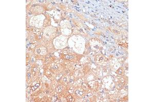 Immunohistochemistry of paraffin-embedded human liver cancer using RIPK3 antibody (ABIN6132598, ABIN6146964, ABIN6146967 and ABIN6221084) at dilution of 1:100 (40x lens). (RIPK3 Antikörper  (AA 1-120))