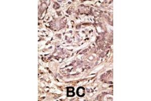 Formalin-fixed and paraffin-embedded human cancer tissue reacted with the primary antibody, which was peroxidase-conjugated to the secondary antibody, followed by AEC staining. (SUMO4 Antikörper  (AA 34-63))