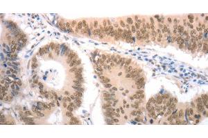 Immunohistochemistry of paraffin-embedded Human colon cancer tissue using RAD52 Polyclonal Antibody at dilution 1:50 (RAD52 Antikörper)