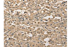 The image on the left is immunohistochemistry of paraffin-embedded Human thyroid cancer tissue using ABIN7128351(ALDH8A1 Antibody) at dilution 1/30, on the right is treated with fusion protein.