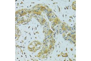 Immunohistochemistry of paraffin-embedded human breast cancer using MTCH1 antibody (ABIN5975695) at dilution of 1/100 (40x lens). (MTCH1 Antikörper)