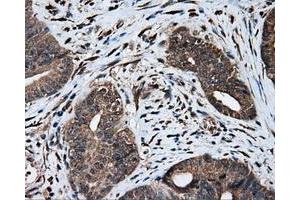 Immunohistochemical staining of paraffin-embedded Adenocarcinoma of colon tissue using anti-MTRF1L mouse monoclonal antibody.