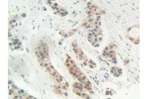 IHC-P analysis of Human Breast cancer Tissue, with DAB staining. (HMGB1 Antikörper  (AA 1-215))