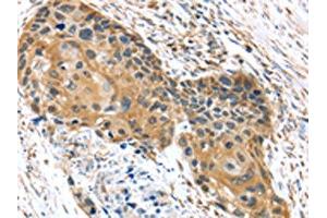 The image on the left is immunohistochemistry of paraffin-embedded Human esophagus cancer tissue using ABIN7192977(UBTD1 Antibody) at dilution 1/30, on the right is treated with synthetic peptide. (UBTD1 Antikörper)