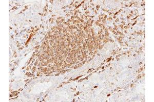 IHC-P Image Immunohistochemical analysis of paraffin-embedded human gastric cancer, using alpha Actin (cardiac muscle), antibody at 1:100 dilution. (ACTC1 Antikörper)
