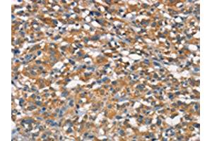 The image on the left is immunohistochemistry of paraffin-embedded Human thyroid cancer tissue using ABIN7189845(APOA1BP Antibody) at dilution 1/15, on the right is treated with synthetic peptide. (APOA1BP Antikörper)
