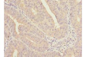 Immunohistochemistry of paraffin-embedded human endometrial cancer using ABIN7161139 at dilution of 1:100 (COBRA1 Antikörper  (AA 8-199))