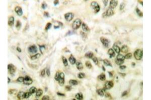Immunohistochemistry analyzes of SMAP45 antibody in paraffin-embedded human breast carcinoma tissue. (HDAC3 Antikörper)