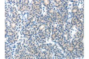 The image on the left is immunohistochemistry of paraffin-embedded Human thyroid cancer tissue using ABIN7128892(CEACAM1 Antibody) at dilution 1/25, on the right is treated with fusion protein. (CEACAM1 Antikörper)