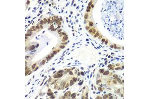 Immunohistochemistry of paraffin-embedded human gastric cancer using RNF2 antibody. (RNF2 Antikörper  (AA 1-336))