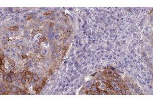 ABIN6275973 at 1/100 staining Human urothelial cancer tissue by IHC-P. (BAI1 Antikörper  (Internal Region))