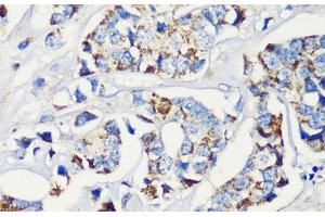 Immunohistochemistry of paraffin-embedded Human breast cancer using KMT2E Polyclonal Antibody at dilution of 1:200 (40x lens). (MLL5/KMT2E Antikörper)