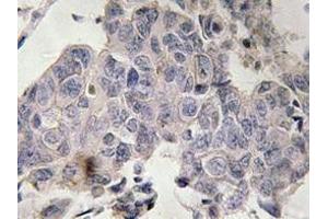 Immunohistochemistry analyzes of STAM2 antibody in paraffin-embedded human lung carcinoma tissue.