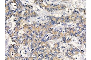 ABIN6261841 and ABIN6278571 at 1/100 staining human colorectal cancer by IHC-P. (FZD7 Antikörper  (C-Term))