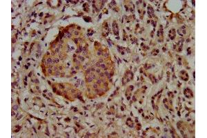 IHC image of ABIN7174451 diluted at 1:500 and staining in paraffin-embedded human pancreatic cancer performed on a Leica BondTM system. (UBE2G1 Antikörper  (AA 2-170))