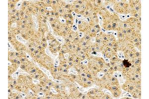 ABIN6257043 and ABIN6275490 at 1/100 staining human liver cancer by IHC-P. (ARHGAP17 Antikörper  (Internal Region))