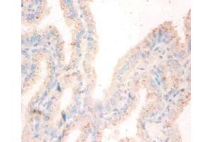Immunohistochemistry of paraffin-embedded human bladder cancer using ABIN7162048 at dilution of 1:50 (NME1 Antikörper  (AA 2-152))