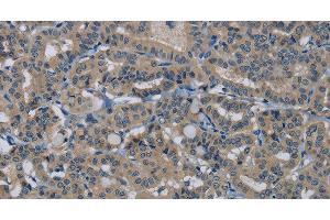 Immunohistochemistry of paraffin-embedded Human thyroid cancer tissue using HSPG2 Polyclonal Antibody at dilution 1:50 (HSPG2 Antikörper)