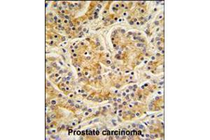 MOBKL1B Antibody IHC analysis in formalin fixed and paraffin embedded human Prostate carcinoma followed by peroxidase conjugation of the secondary antibody and DAB staining. (MOB1A Antikörper  (C-Term))
