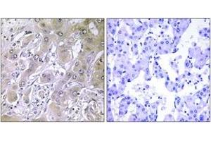 Immunohistochemistry analysis of paraffin-embedded human liver carcinoma tissue, using ACOT12 Antibody. (ACOT12 Antikörper  (AA 281-330))