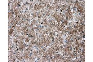 Immunohistochemical staining of paraffin-embedded Carcinoma of liver tissue using anti-TPMT mouse monoclonal antibody. (TPMT Antikörper)