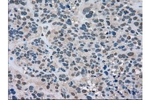Immunohistochemical staining of paraffin-embedded Carcinoma of kidney tissue using anti-LDHAmouse monoclonal antibody. (Lactate Dehydrogenase A Antikörper)