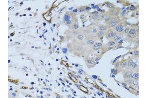 Immunohistochemistry of paraffin-embedded human breast cancer using MCAM antibody. (MCAM Antikörper)