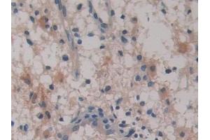 Detection of PTI in Human Glioma Tissue using Polyclonal Antibody to Placental Thrombin Inhibitor (PTI)