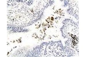 Immunohistochemiacl staining of human lung carcinoma tissue section with GPR182 polyclonal antibody  at 1:200 dilution. (G Protein-Coupled Receptor 182 Antikörper)