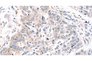 Immunohistochemistry of paraffin-embedded Human lung cancer tissue using ROR1 Polyclonal Antibody at dilution 1:45 (ROR1 Antikörper)