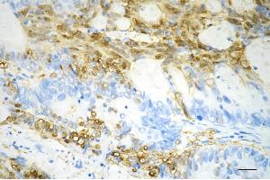 Immunohistochemistry was performed on paraffin-embedded human sigmoid colon carcinoma using creatine kinase B antibody (ABIN7798162), 1:200). (Rekombinanter CKB Antikörper)